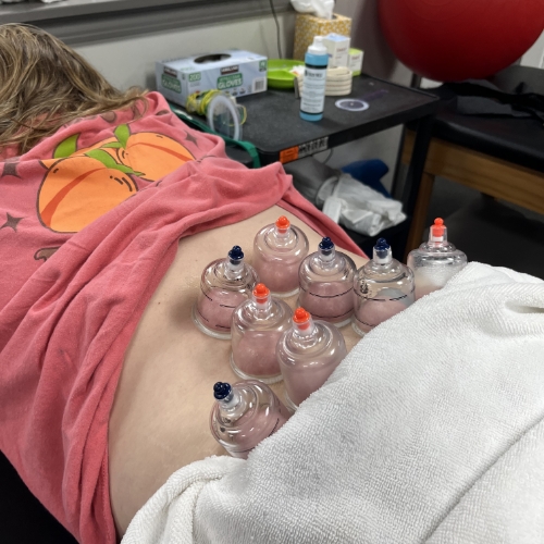 cupping-Back-In-The-Game-Physical-Therapy-Flowery-Branch-GA-Dacula-GA-Suwanee-GA-Gainesville-GA